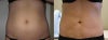 Lipotherme before & after photos