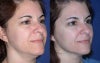 Ultherapy before & after photos
