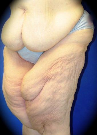Thigh Lift