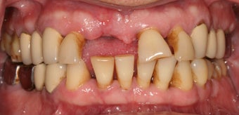 Severely broken upper teeth