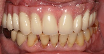 Severely broken upper teeth