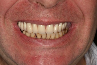 Severely broken upper teeth
