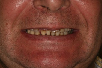 Severely broken upper teeth