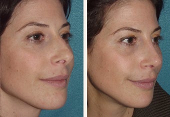 40 year-old female with a complex deviated nasal septum 