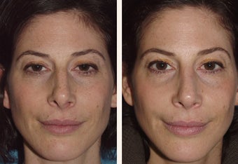 40 year-old female with a complex deviated nasal septum 