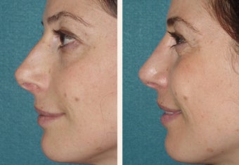 40 year-old female with a complex deviated nasal septum 