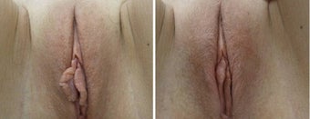 Labiaplasty