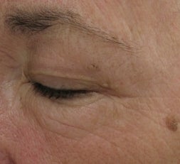 Crows feet and eye wrinkles treated with 1 treatment of Lux 1540 Fractional Laser