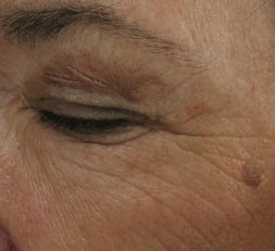 Crows feet and eye wrinkles treated with 1 treatment of Lux 1540 Fractional Laser