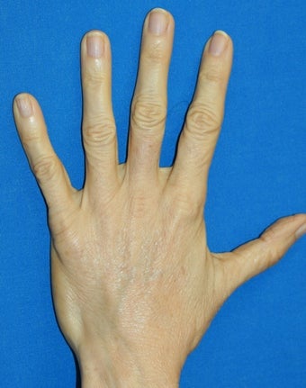 Hand Rejuvenation with Filler