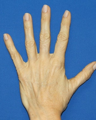 Hand Rejuvenation with Filler