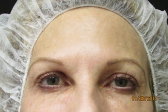 Ultherapy Eye Lift