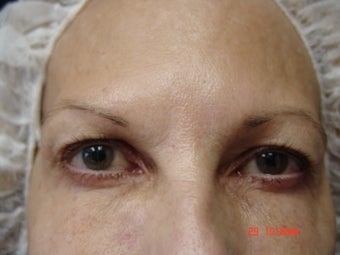 Ultherapy Eye Lift