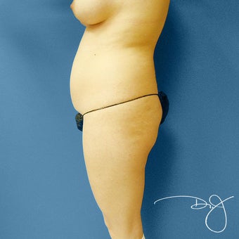 Brazilian Buttock Augmentation