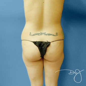 Brazilian Buttock Augmentation