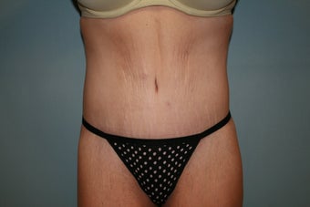 Total Body Lift