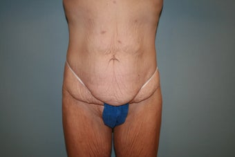 Total Body Lift