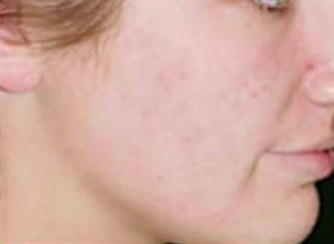 Mesotherapy