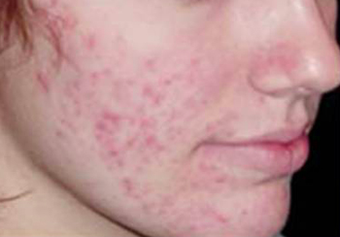 Mesotherapy