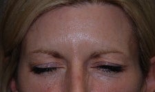 Botox to Forehead and Frown Wrinkles