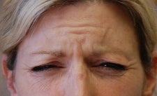 Botox to Forehead and Frown Wrinkles