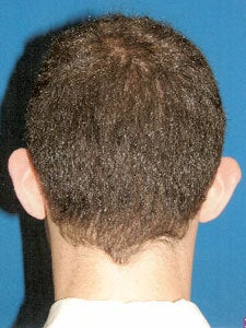 Otoplasty Ear Surgery - Boy