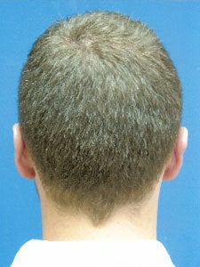 Otoplasty Ear Surgery - Boy