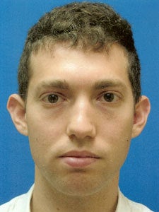 Otoplasty Ear Surgery - Boy