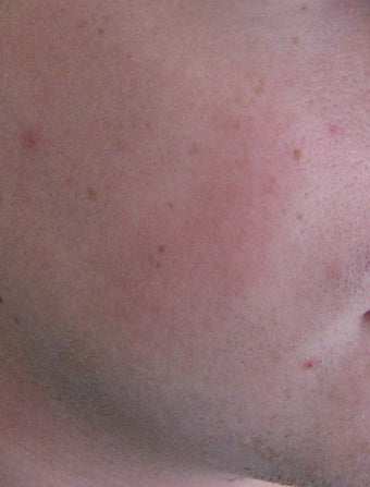 24 year old Male with Rosacea