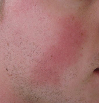 24 year old Male with Rosacea