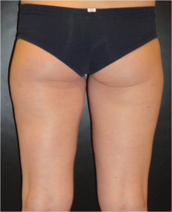 SmartLipo MPX