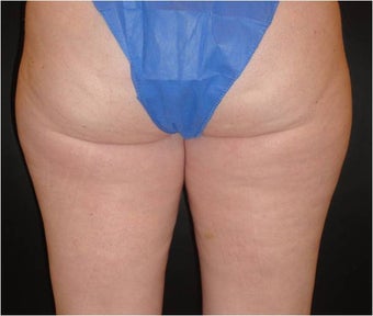 SmartLipo MPX