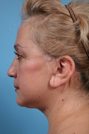 Necklift Patient