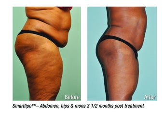 Smartlipo abdomen, hips & mons 3 mos post treatment -61 yr. old