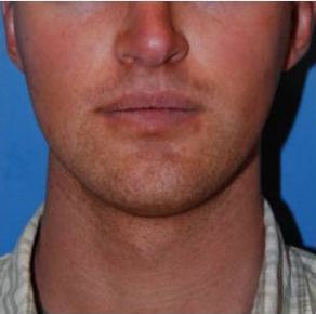 Before and After Laterasl Jaw Augmentation with Silicone Implants