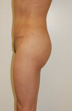 buttock Augmentation