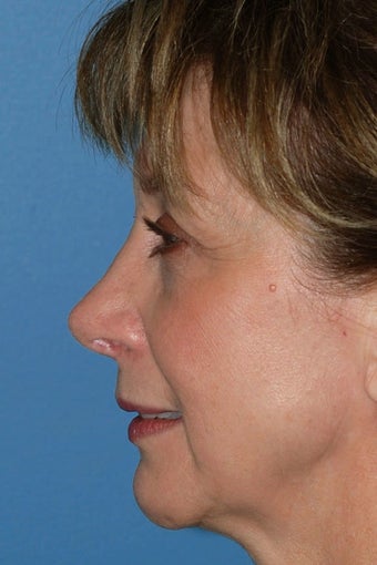 Revision Rhinoplasty