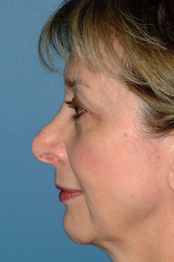Revision Rhinoplasty