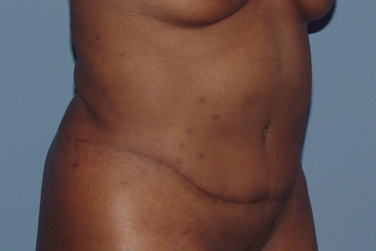 Tummy tuck (abdominoplasty) redo (secondary)