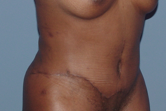 Tummy tuck (abdominoplasty) redo (secondary)