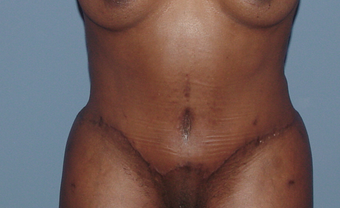 Tummy tuck (abdominoplasty) redo (secondary)