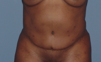 Tummy tuck (abdominoplasty) redo (secondary)