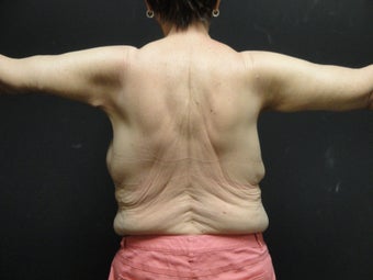 Arm lift