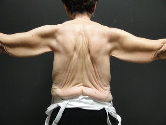 Arm lift