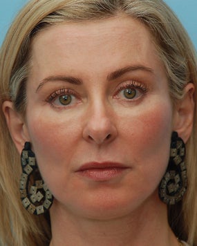 Cheek Augmentation Using Juvederm
