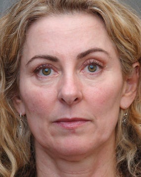 Cheek Augmentation Using Juvederm