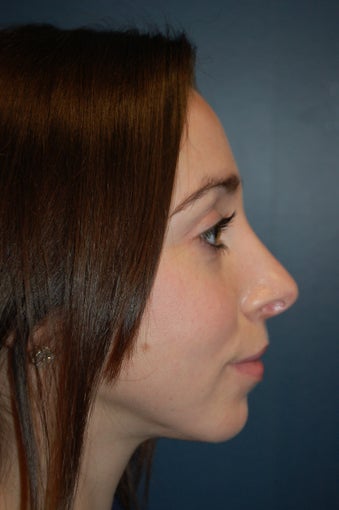 Nose Surgery