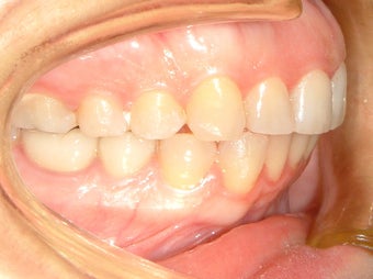overbite