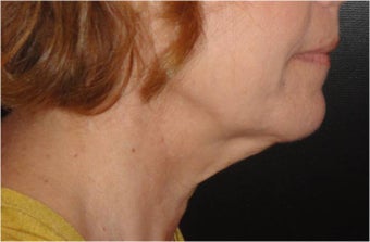 SmartLipo MPX