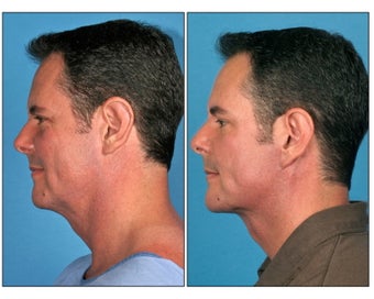 Neck Lift